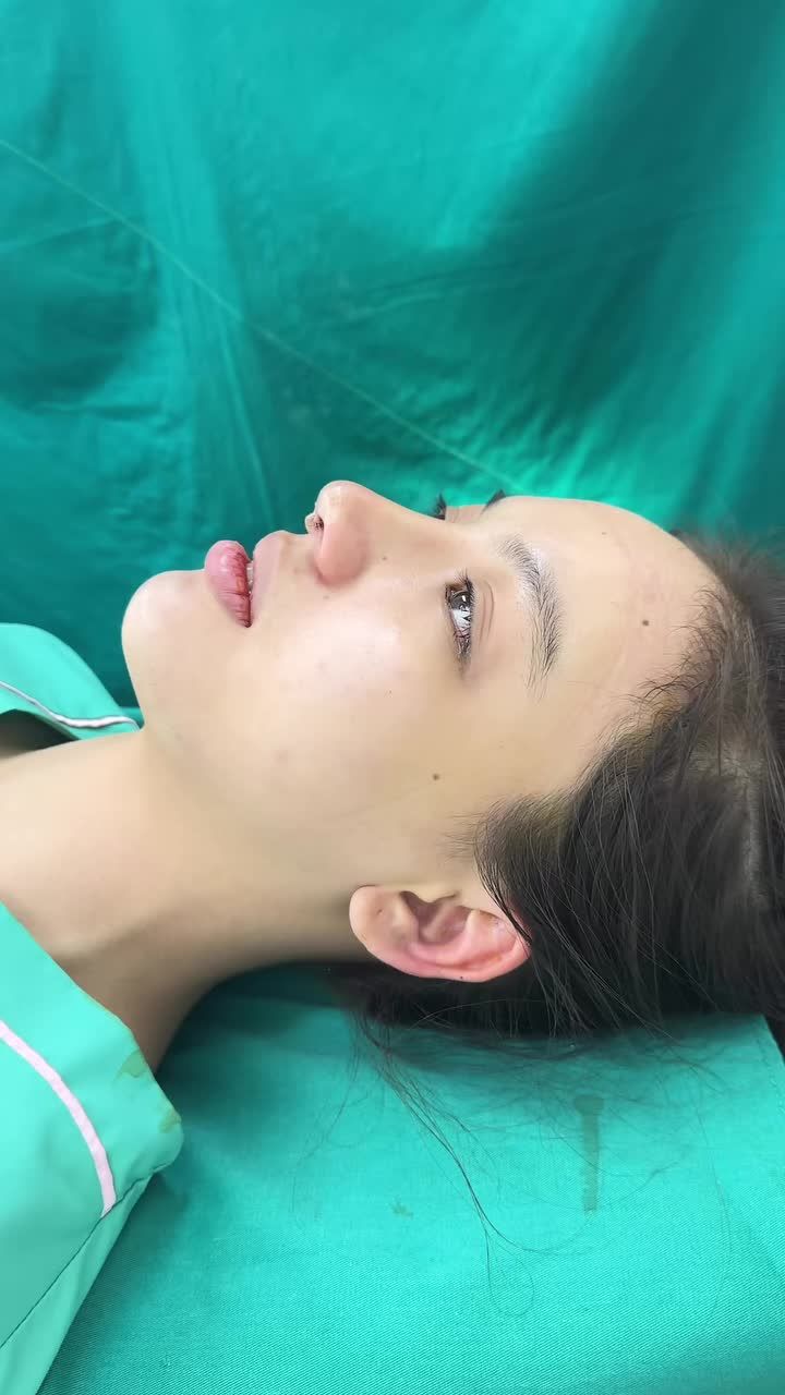 Case Nâng mũi + Độn cằm  ''Lột xá.c'' gương mặt đẹp hài hòa, cân đối, sắc nét!!