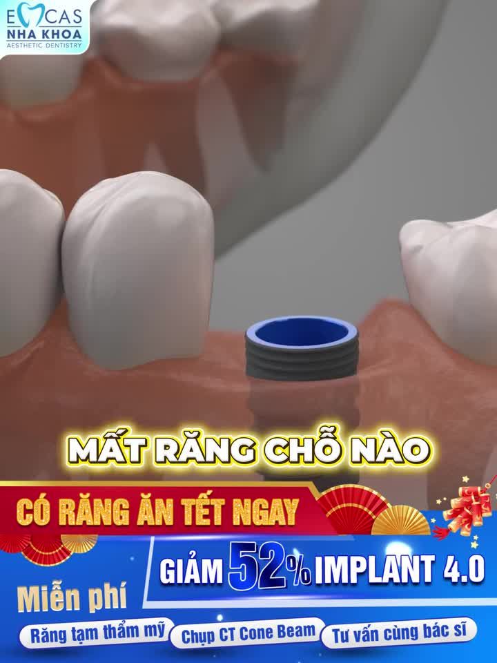 MẤT 1 RĂNG, MẤT NHIỀU RĂNG, MẤT RĂNG TOÀN HÀM