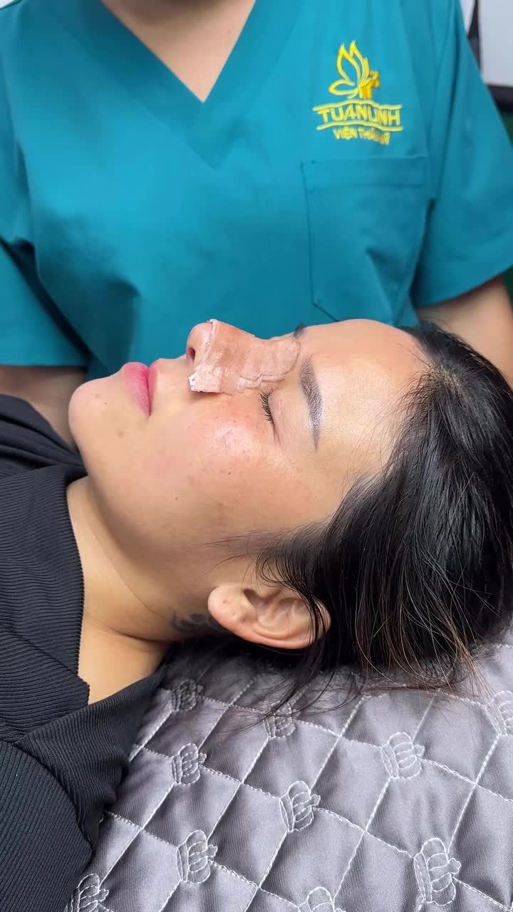 Case Nâng mũi cấu trúc kết hợp chỉnh hình xương sau 10 ngày tái khám!!