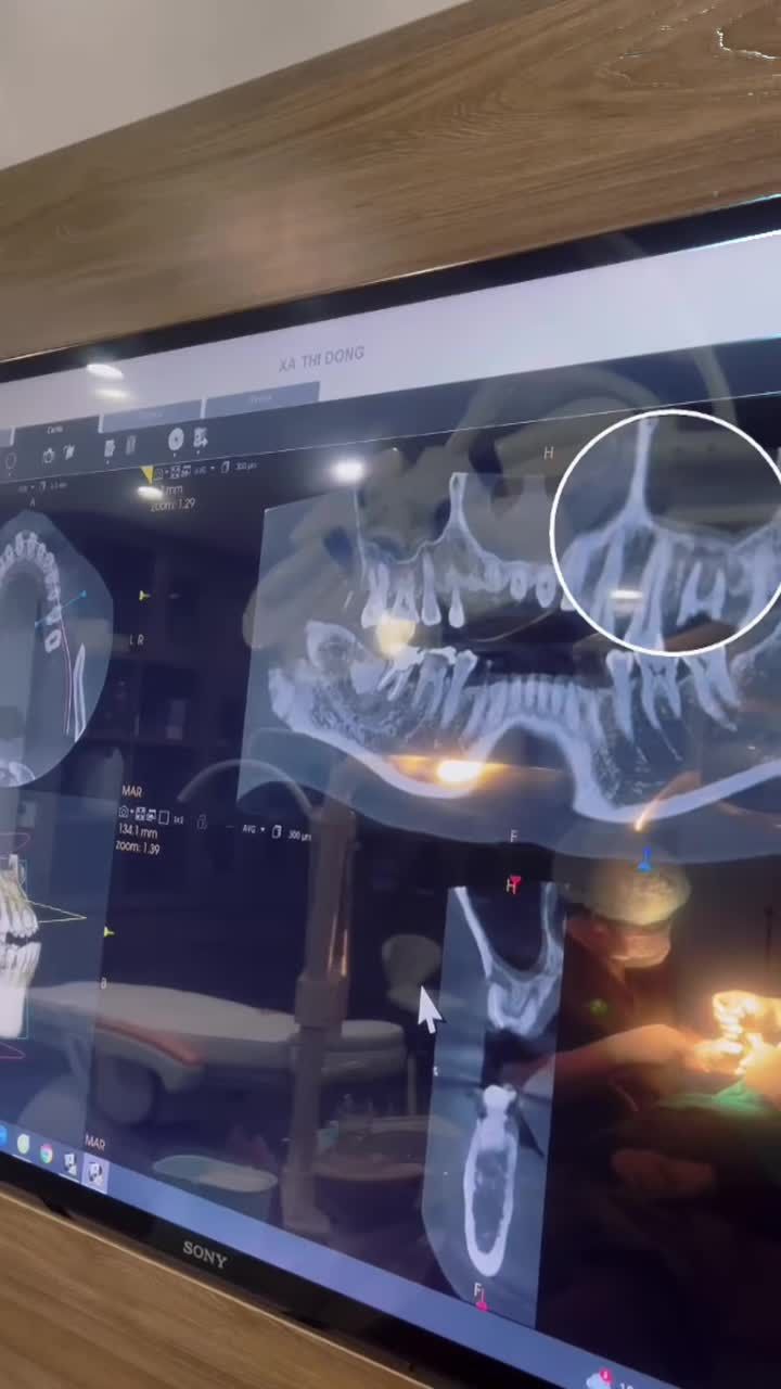 NHỔ RĂNG NHANH LÀNH – KỊP ĐÓN TẾT AN TÂM