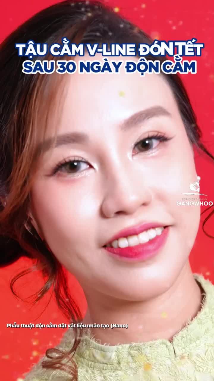 Độn cằm chuẩn V-Line - Tự tin khoe góc nghiêng ngày xuân