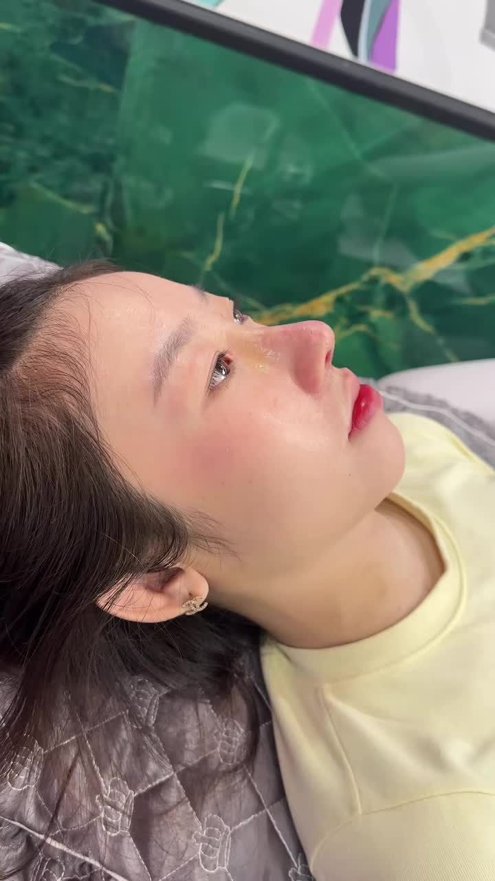 Mũi cấu trúc sau 10 ngày