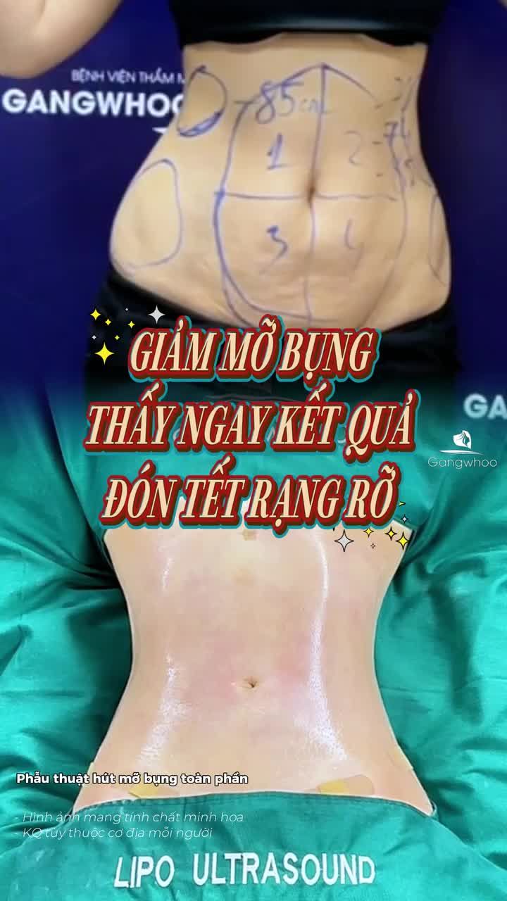 Đón Tết rạng rỡ hơn chỉ khi loại bỏ được nỗi tự ti suốt bao năm Kết quả trực tiếp sau 60 phút thực hiện phẫu thuật