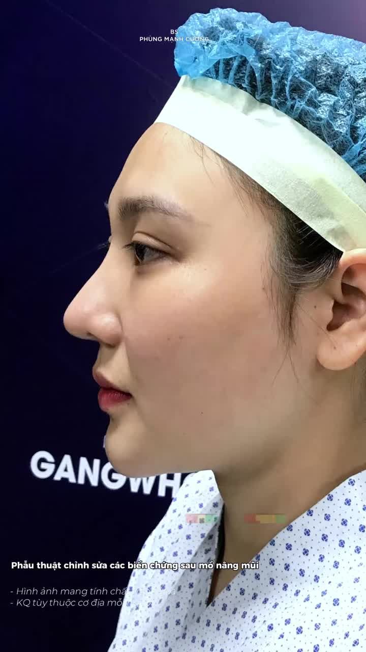 Sống mũi đơ cứng vì nâng quá cao và kết quả sau 30 ngày sửa lại