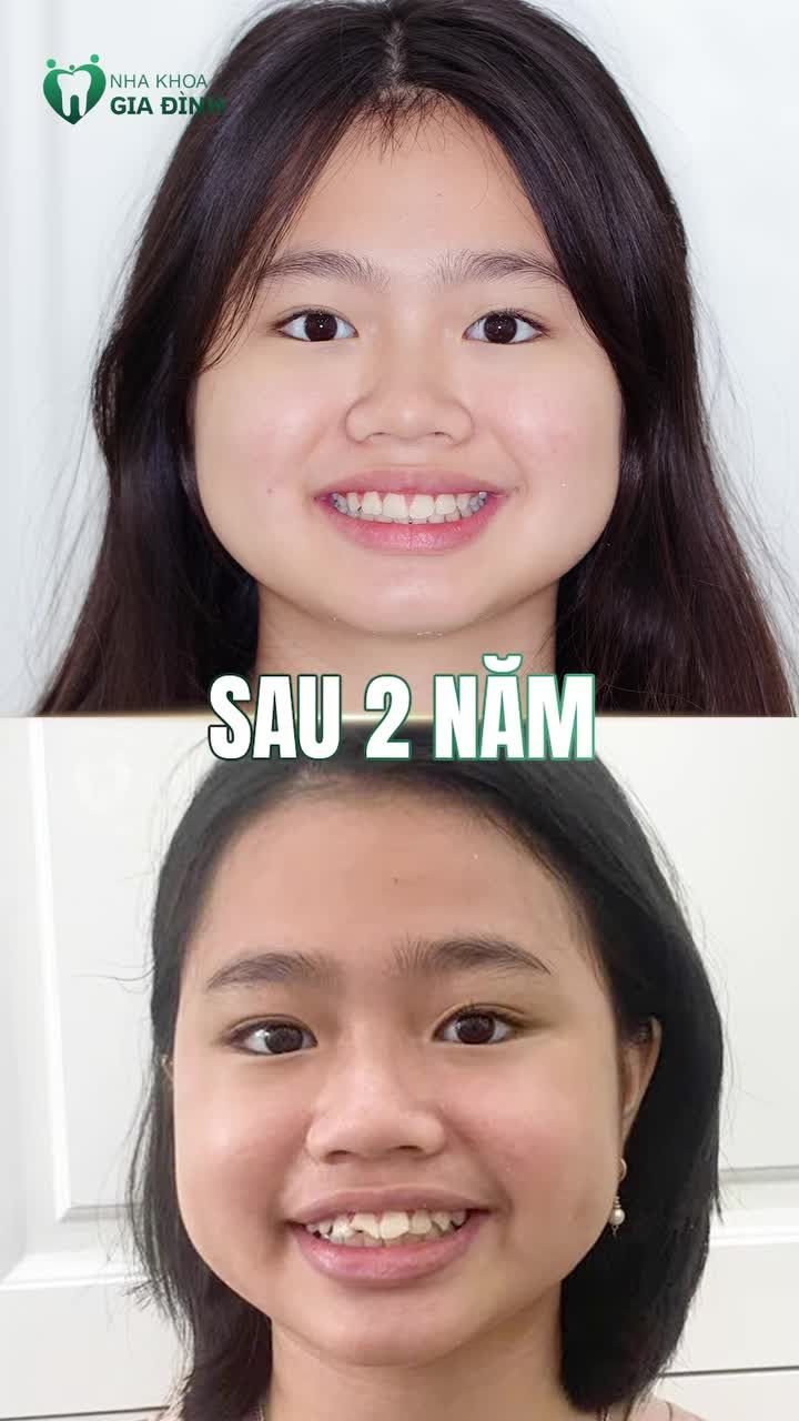 BÁC SĨ LÂM TRANG PHÂN TÍCH CA LÂM SÀNG TRƯỚC KHI THÁO NIỀNG