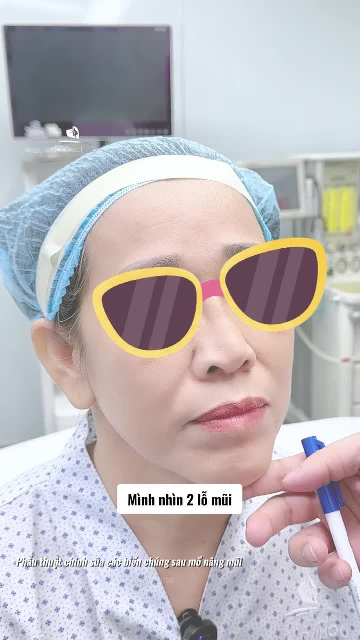 Sụn lắc lư vì nâng mũi đặt dưới da và hành trình sửa mũi lại tại BVTM Gangwhoo