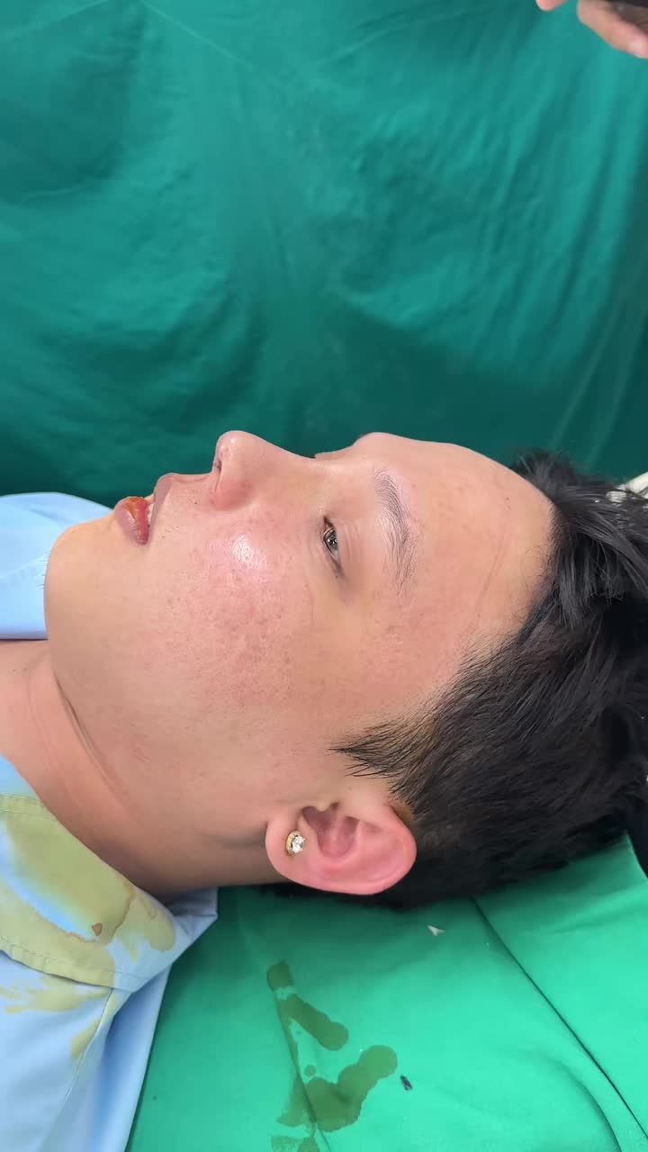 Mũi cấu trúc nam vừa hoàn thành!!