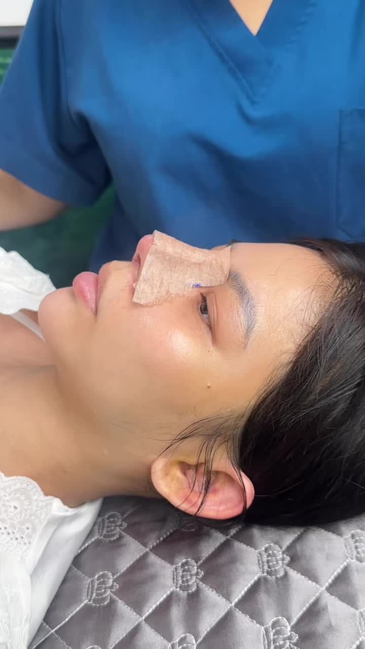 Case nâng mũi cấu trúc tái khám sau 5 ngày!!