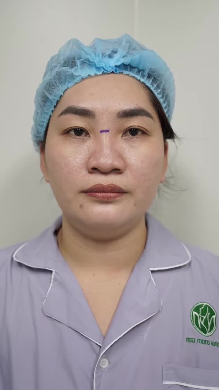 Màn biến hình cuối năm sau khi Nâng Mũi.