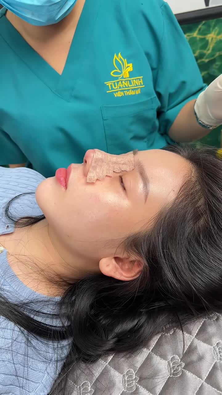 Case nâng mũi cấu trúc Surgiform tái khám sau 10 ngày!!