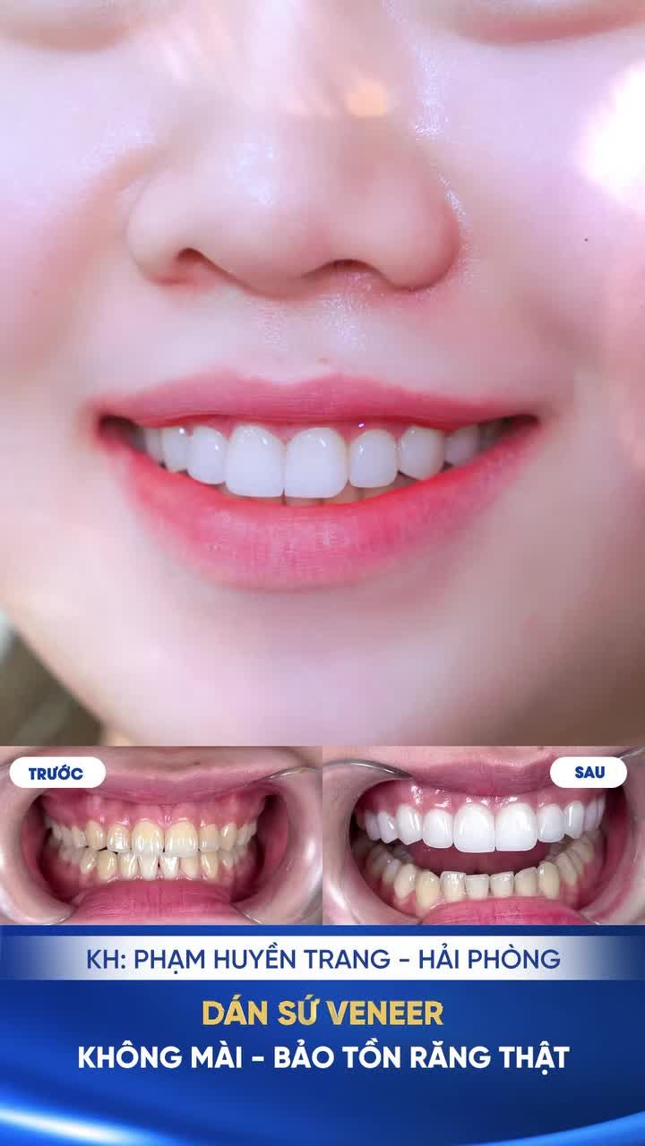 NỤ CƯỜI MỚI – TỰ TIN MỚI CÙNG SHINBI DENTAL