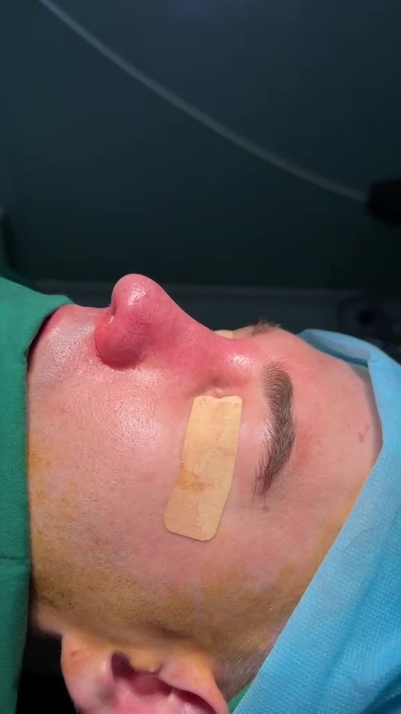 BẤT NGỜ: Bác sĩ JW giúp anh khách người Nga sở hữu dáng mũi CAO chuẩn tỷ lệ vàng ngay trên bàn phẫu thuật với NÂNG MŨI S LINE 3D