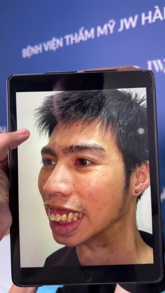 NÓNG: Nam khách hàng 9X xóa sổ 30 NĂM MẶC CẢM, tái sinh diện mạo CỰC ĐIỂN TRAI sau Phẫu thuật hàm hô tại JW