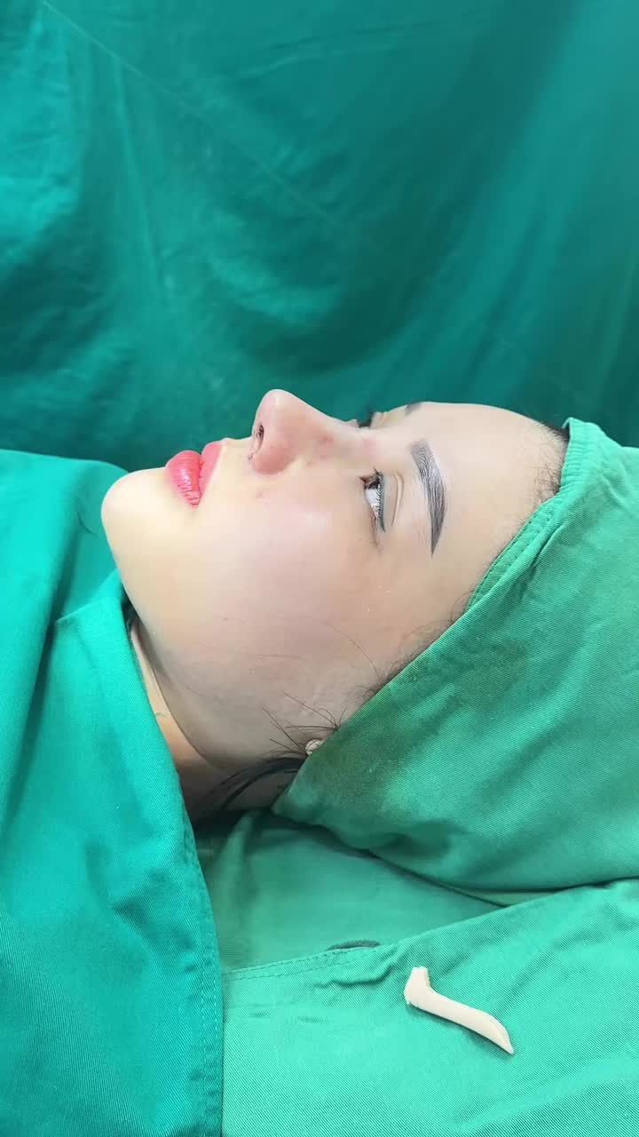 Case nâng mũi cấu trúc sửa lại sử dụng sóng Surgiform!!