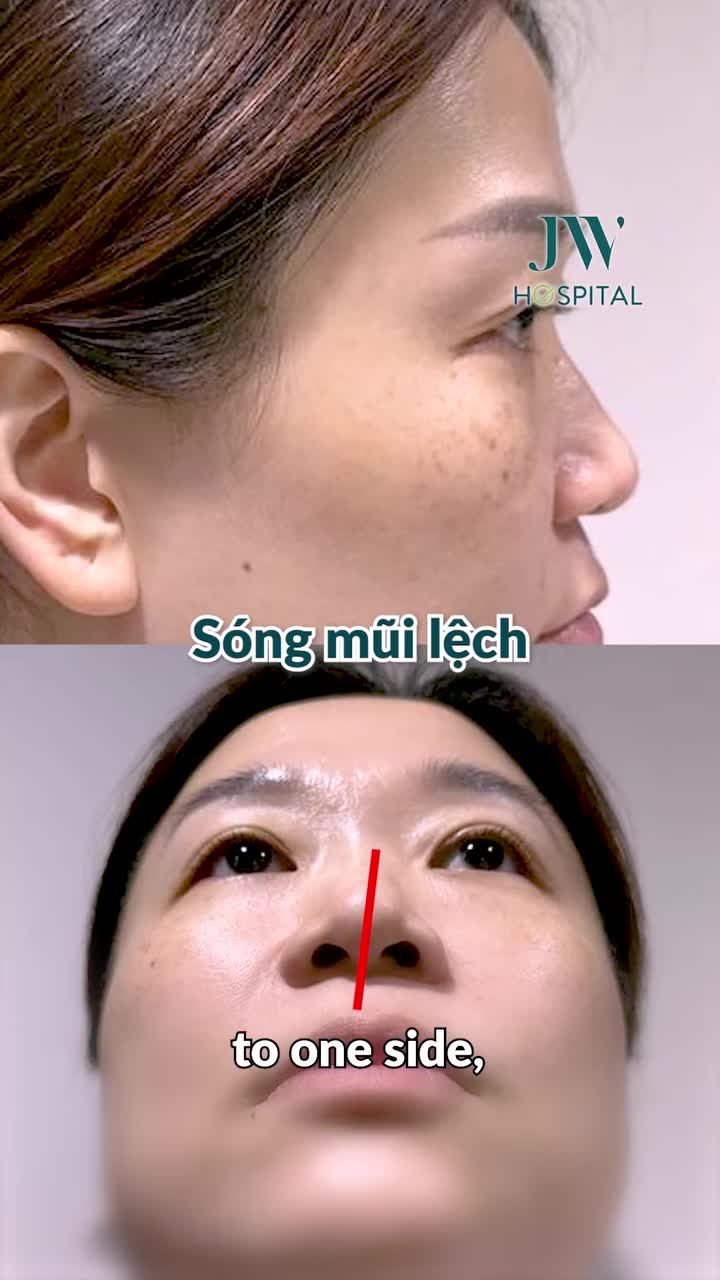 BÁC SĨ TÚ DUNG NÂNG MŨI THEO CHATGPT AI ĐẸP SANG CHẢNH CHO CHỊ KHÁCH SINGAPORE  TIẾT KIỆM 4 TRIỆU