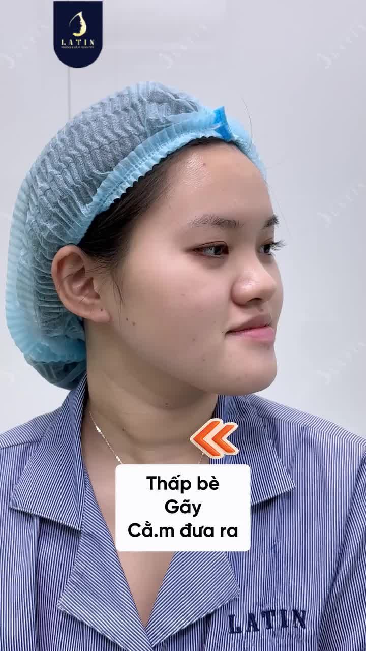 GIẢI CỨU GƯƠNG MẶT GÃY CHỈ QUA MỘT DÁNG MŨI MỚI