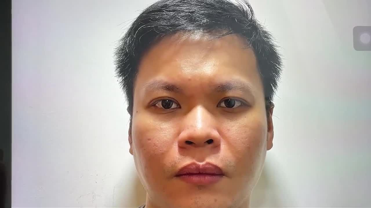 SIÊU NÓNG: Cặp bạn thân xuyên lục địa cùng đến JW Nâng mũi TRÙNG TU NHAN SẮC đón Tết