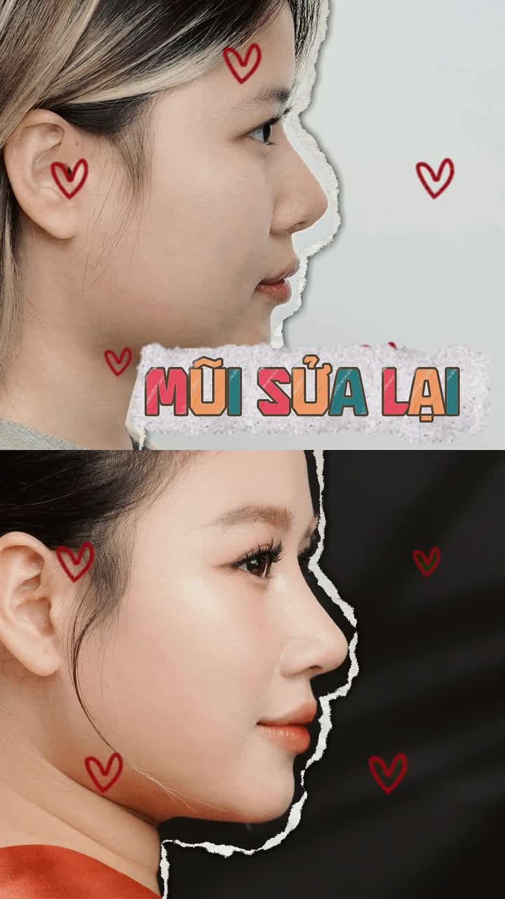 Cải thiện tình trạng ngắn hếch sau nâng mũi nhân tạo cho khách hàng 2k.