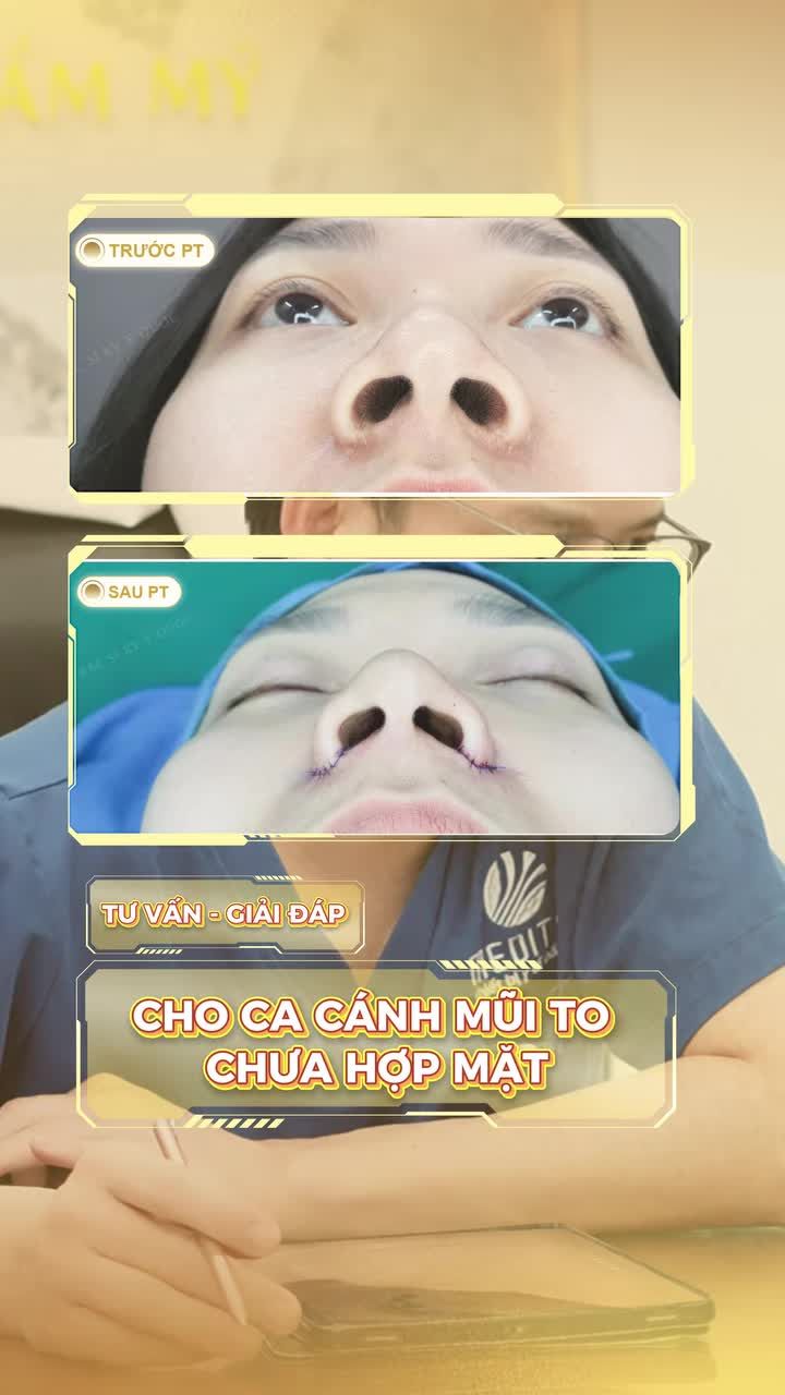 Tư vấn dọn gọn cánh mũi sao cho hợp mặt