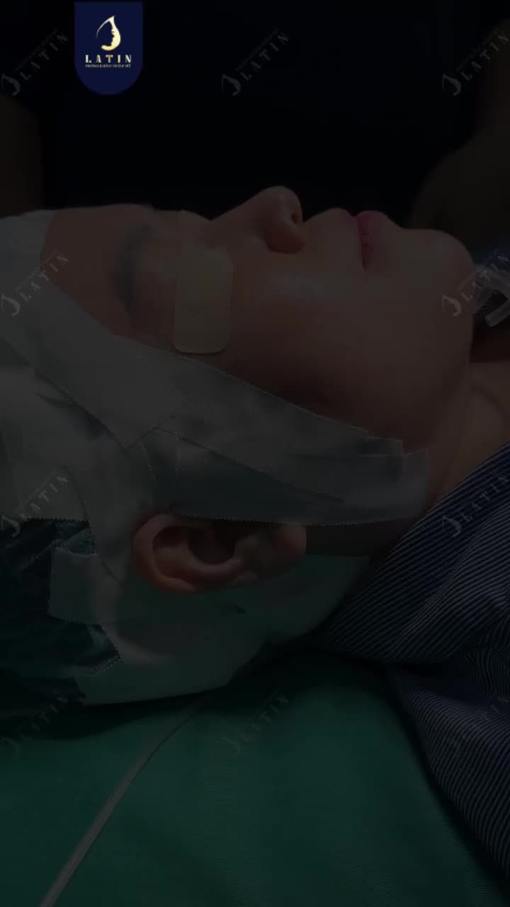 DÁNG MẶT THON GỌN HƠN BẮT ĐẦU TỪ VỊ TRÍ CHIẾC MŨI