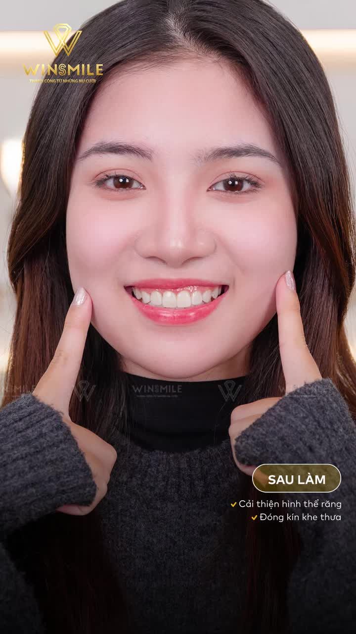 6 răng Veneer siêu siêu mỏng, không cần mài cứ gọi là chân ái trong lòng khách hàng khi đặt niềm tin vào kỹ thuật của đội ngũ bác sĩ kinh nghiệm của Win Smile.