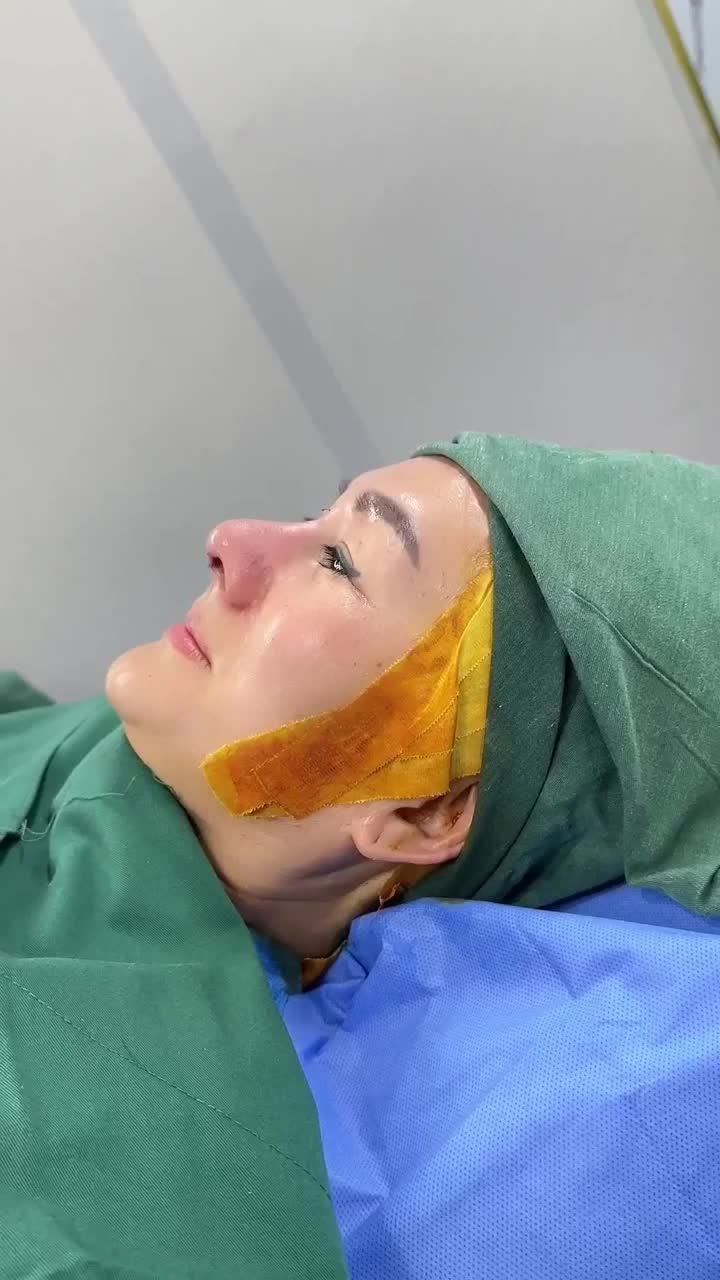 NÂNG MŨI CẤU TRÚC SỤN SƯỜN DR. HOẠT