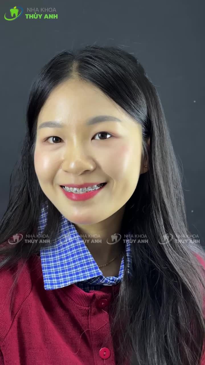 NIỀNG RĂNG – BỪNG SÁNG BÍNH NGỌ, BỨT PHÁ NỤ CƯỜI MỚI