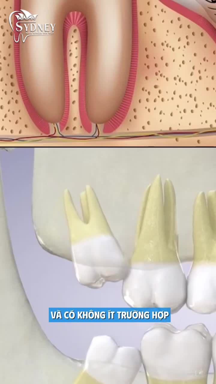 Những dấu hiệu mọc răng khôn bạn cần lưu ý