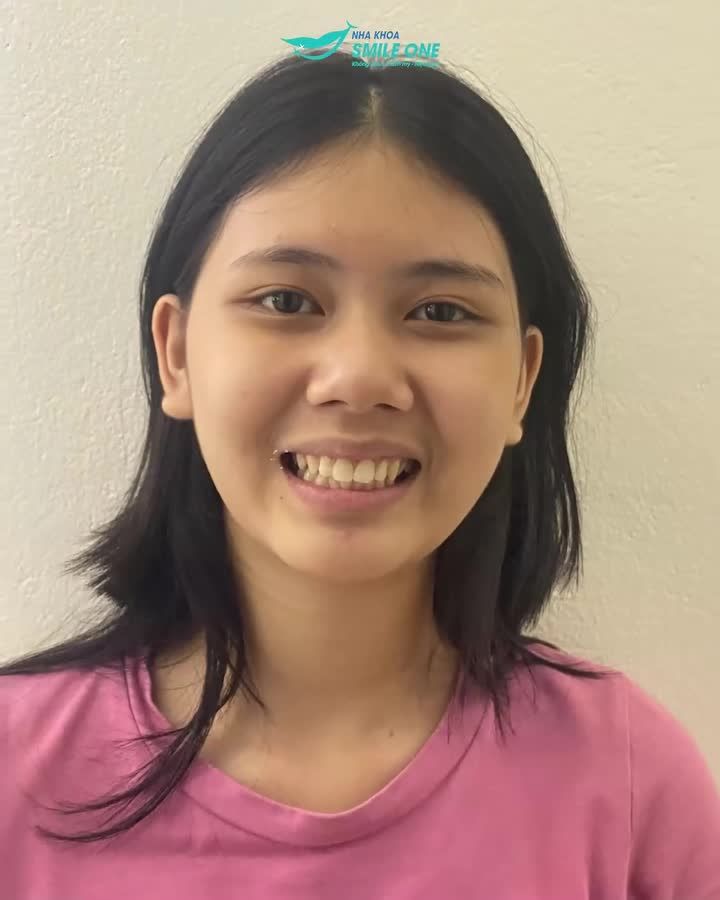 2 năm sau Niềng răng của Nhật Linh...