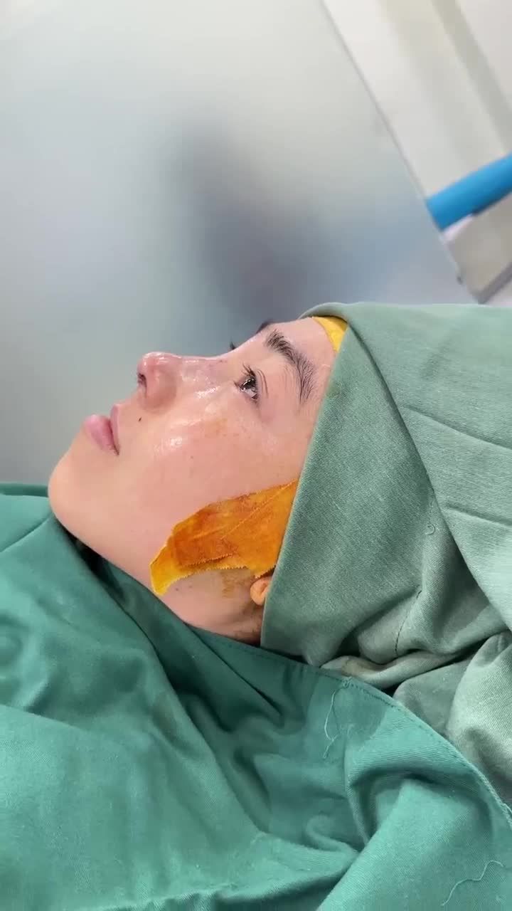 SAU 60 PHÚT NÂNG MŨI CẤU TRÚC CÓ NGAY MŨI ĐẸP NHƯ Ý