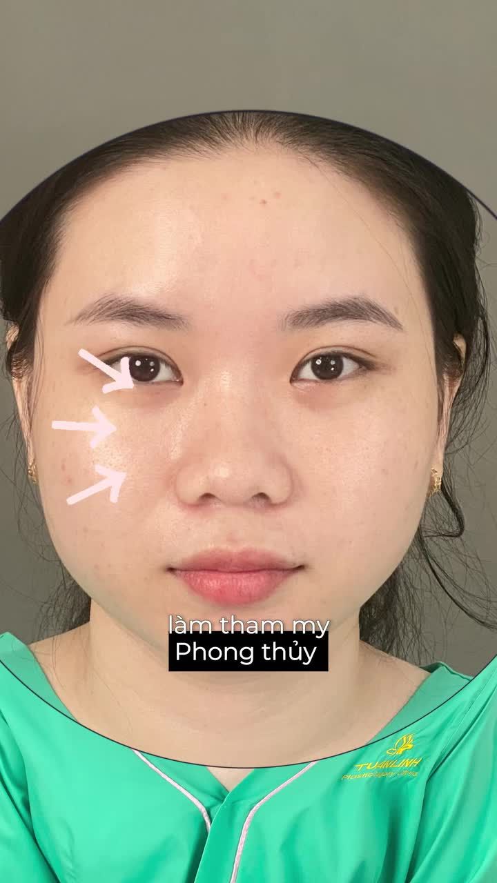 NÂNG MŨI CẤU TRÚC DÁNG THIẾT KẾ – CÂN CHỈNH TỈ LỆ GƯƠNG MẶT CHUẨN HÀI HÒA