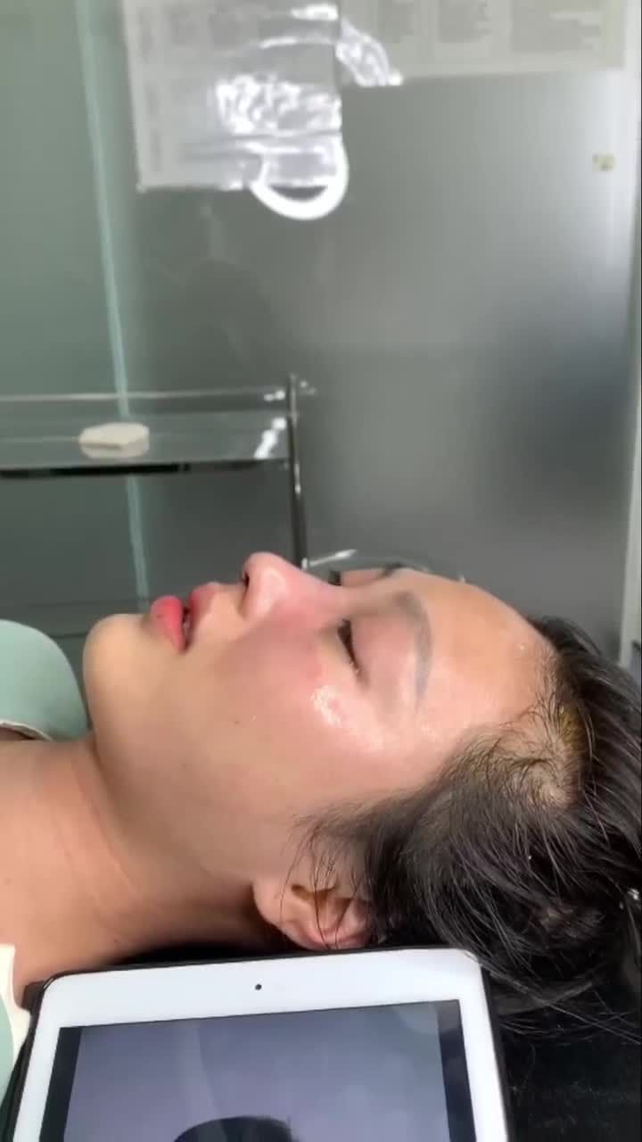 KẾT QUẢ SAU 60 PHÚT NÂNG MŨI CẤU TRÚC DR. HOẠT