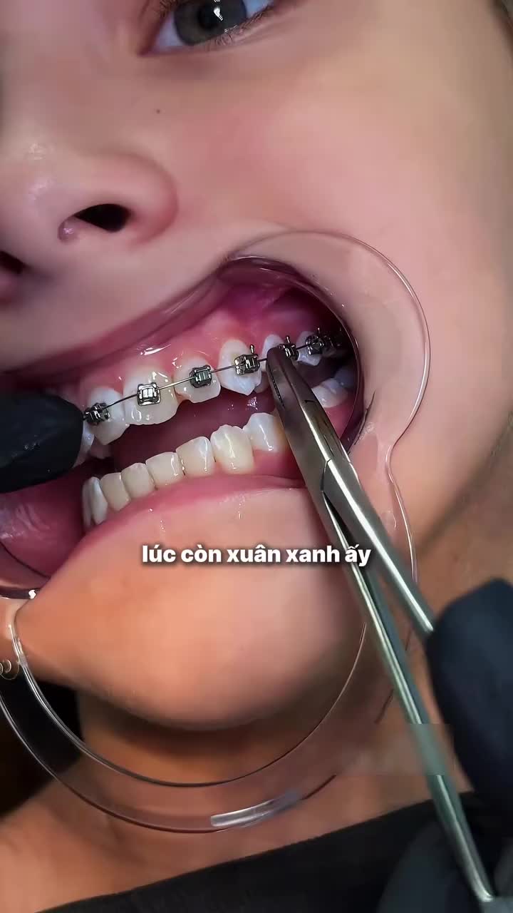 35 tuổi có niềng răng được không? Cùng Viet Smile xem hết video để có câu trả lời nhé!
