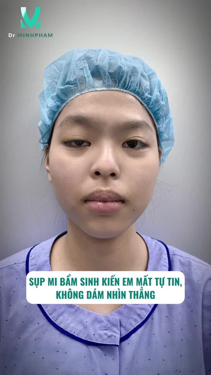 Phẫu thuật sụp mi bẩm sinh đã thay đổi bạn Hải Anh thế nào?