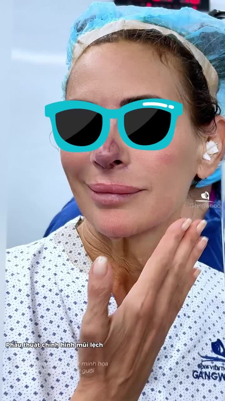 Combo sửa mũi lệch + thu nhỏ đầu mũi cho khách hàng quốc tế