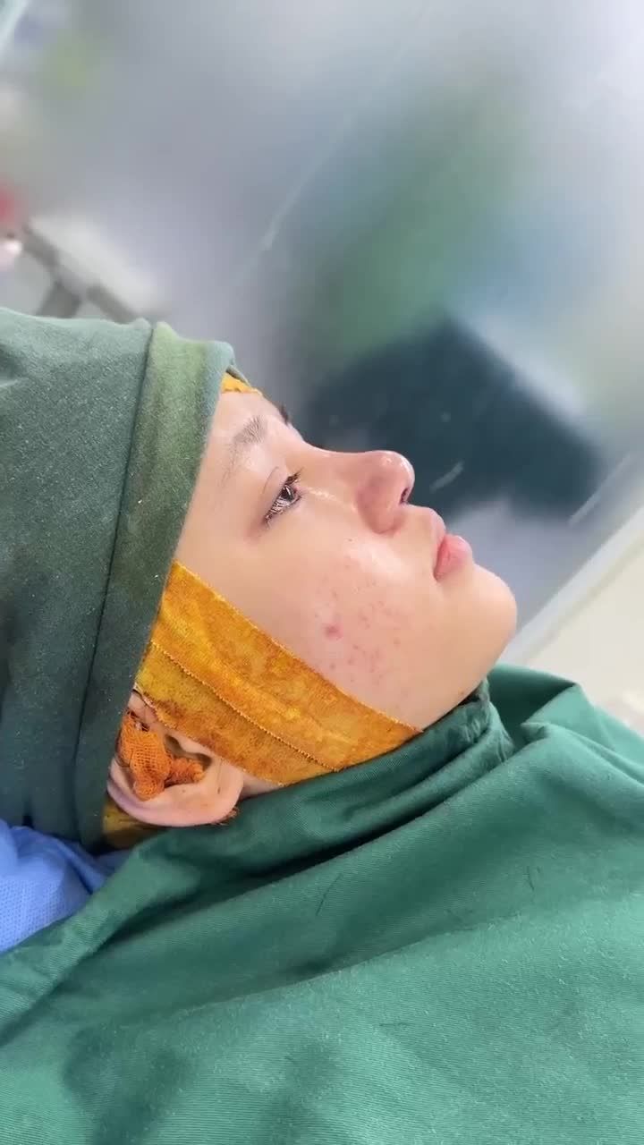 KẾT QUẢ SAU 60 PHÚT NÂNG MŨI SỤN SURGIFORM