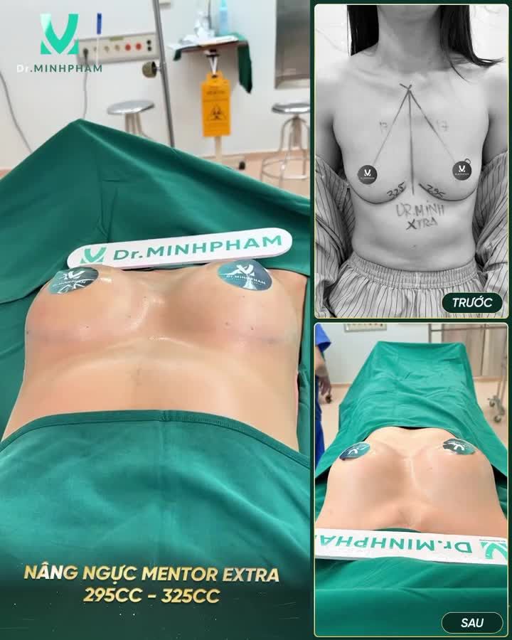 NÂNG NGỰC MENTOR XTRA 295CC – 325CC