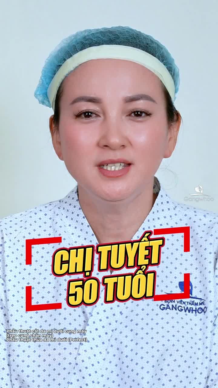 Treo cung chân mày cắt mí dưới