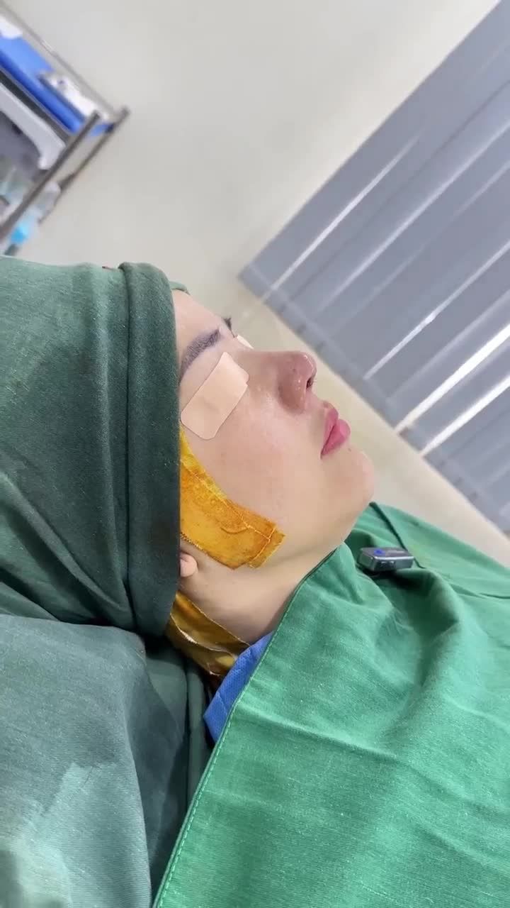 KẾT QUẢ SAU 60 PHÚT NÂNG MŨI SỬA LẠI CÙNG DR. HOẠT