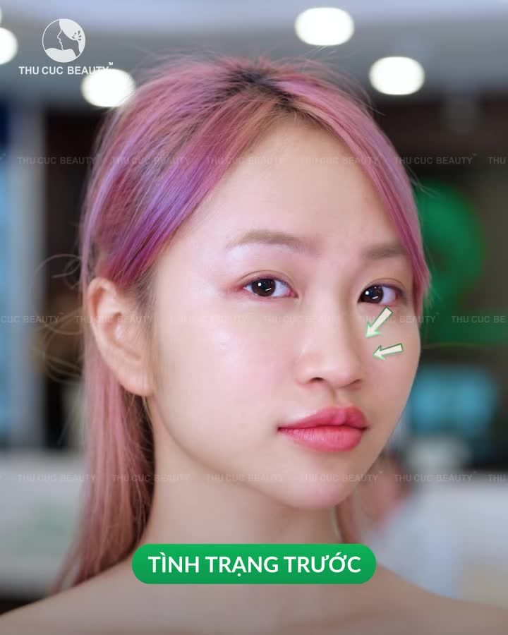 Hô biến mũi tẹt hoá mũi cao thanh tú