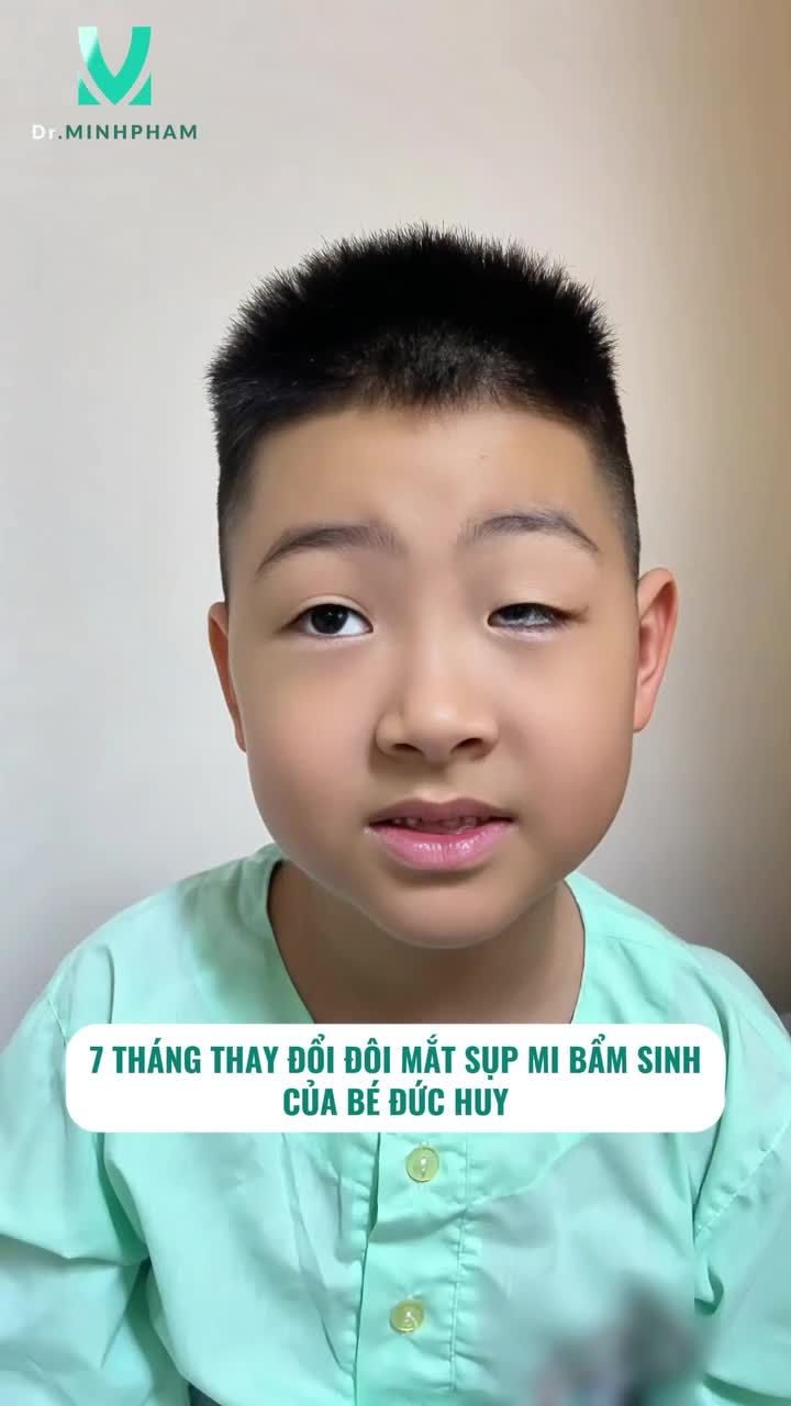 BÉ ĐỨC HUY SAU 7 THÁNG PHẪU THUẬT SỤP MI