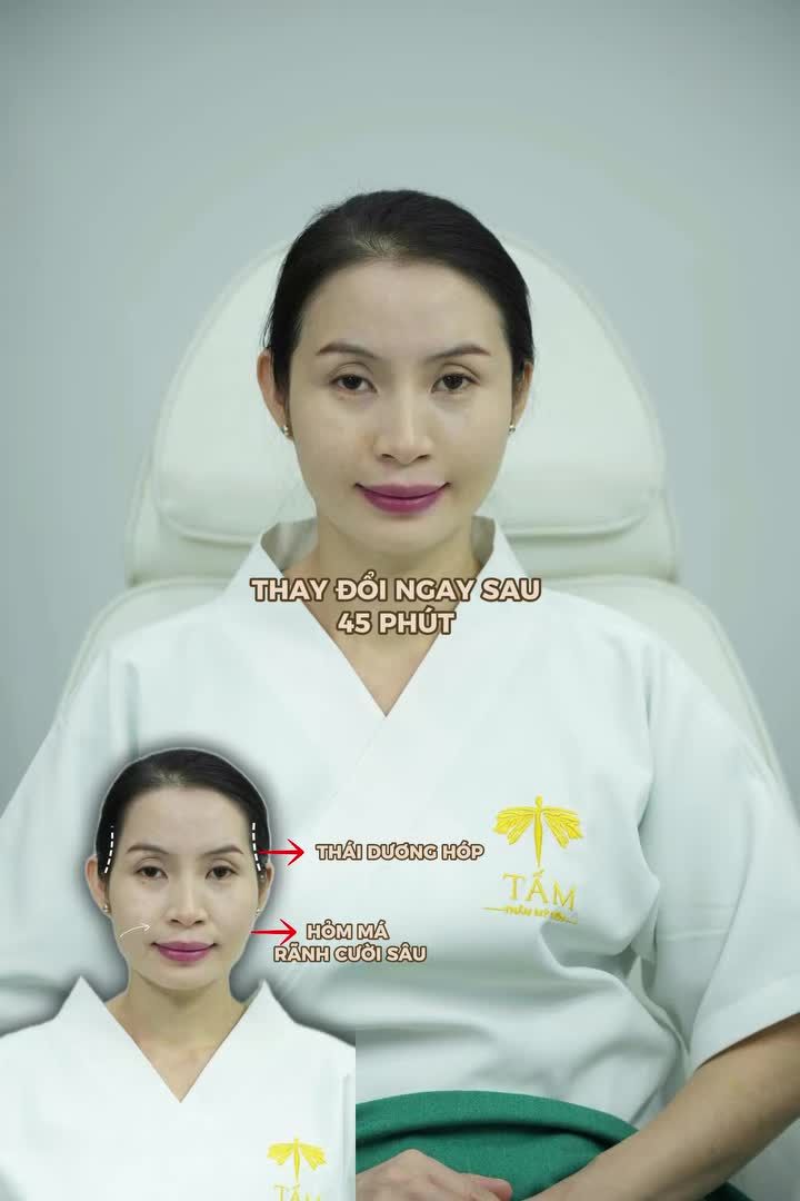 Sau 1 lần filler tại Tấm, chị Tiên chia sẻ:""Bây giờ cảm thấy trẻ ra và tự tin hơn nhiều "" Sự thay đổi này không chỉ mang lại cho chị sự hài lòng mà còn là sự ghi nhận với đội ngũ y bác sĩ tại Tấm.