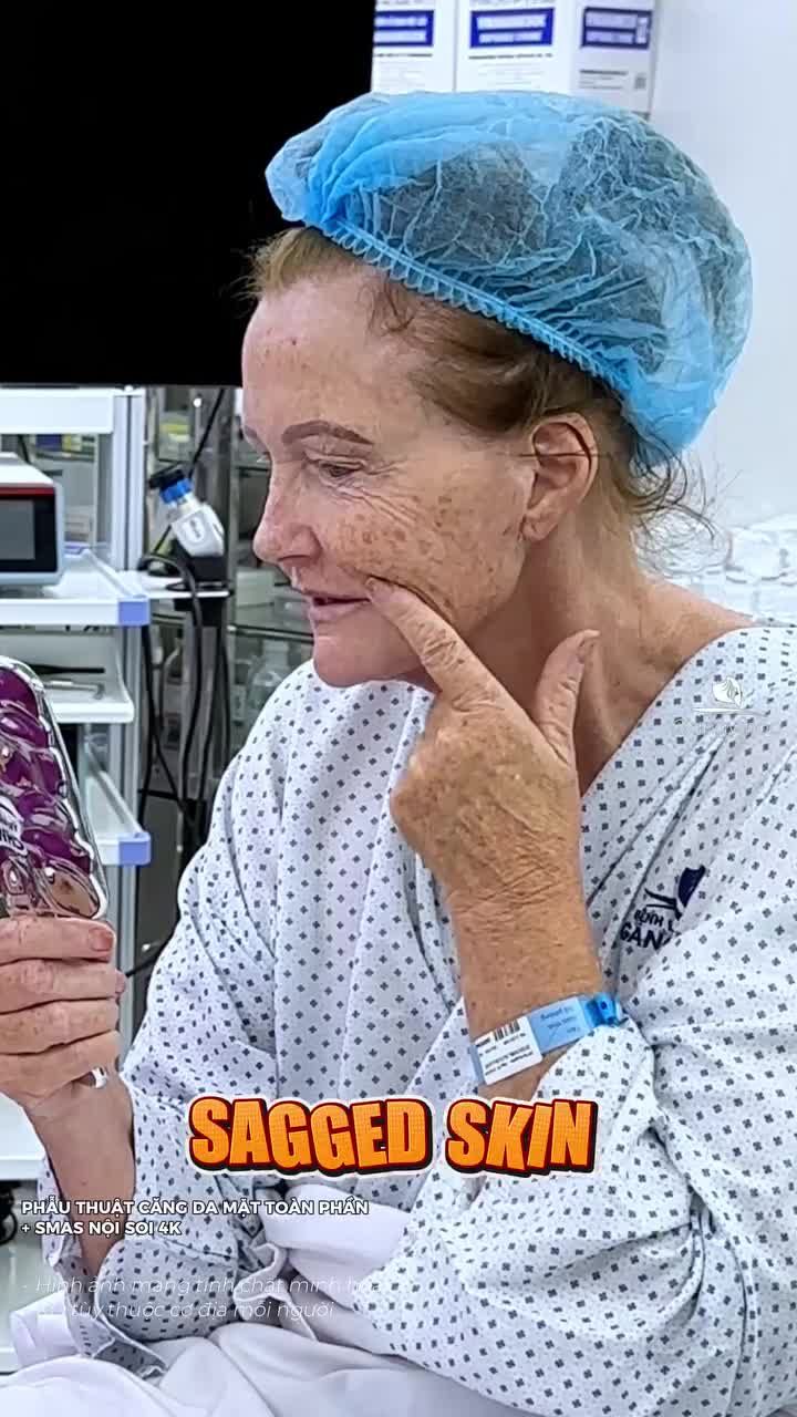 Chị Khách Quốc Tế muốn trẻ lại 1 lần nữa với phẫu thuật căng da mặt toàn phần + Smas nội soi 4K. Cùng chờ đón kết quả p2 nhé!