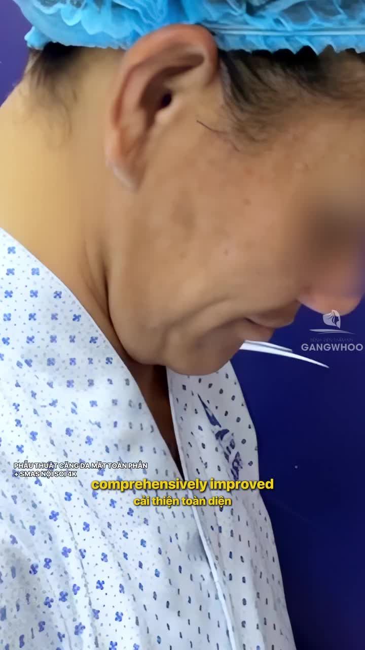 Sự thay đổi rõ rệt giữa trước và sau khi thực hiện phẫu thuật căng da mặt toàn phần + Smas nội soi 4K nhẹ nhàng - an toàn - hiệu quả