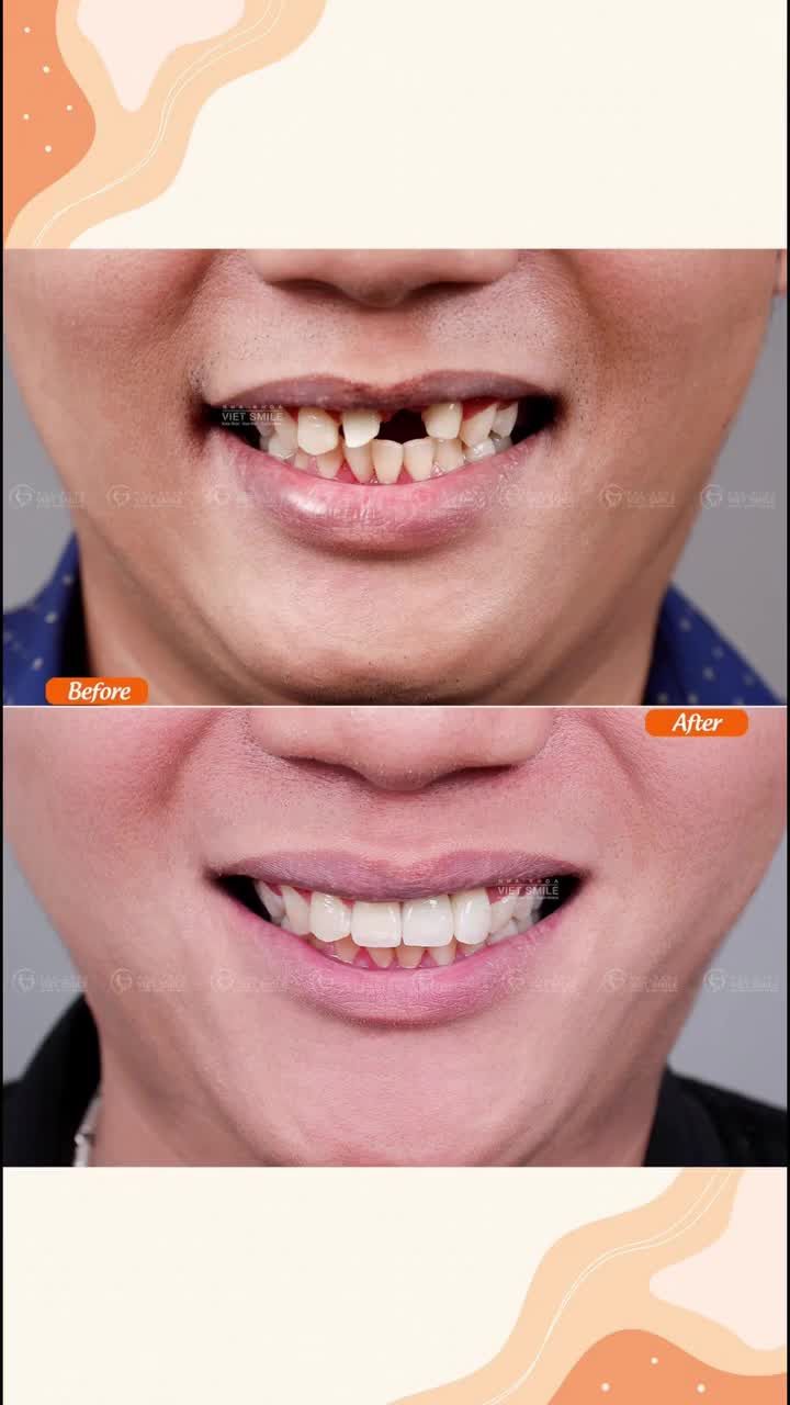 Lấy lại sự tự tin và nụ cười rạng rỡ nhờ trồng răng Implant và bọc sứ thẩm mỹ