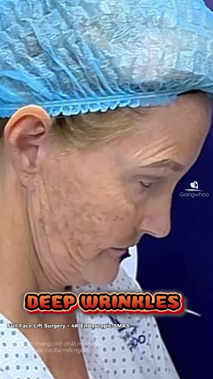 Kết quả sau phẫu thuật căng da mặt toàn phần + Smas nội soi 4K khiến chị khách Quốc Tế phải wow, khen nức nở khi nhìn vào gương mặt mới của mình