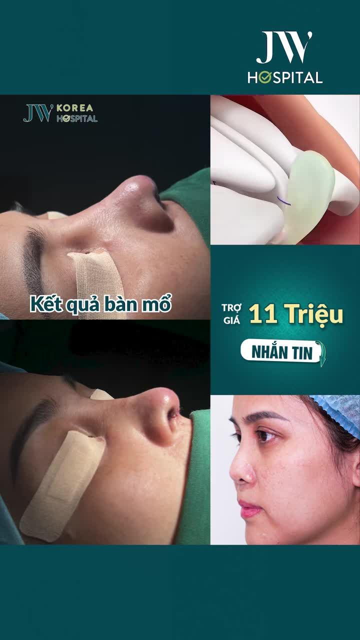 BÁC SĨ TÚ DUNG XOÁ MŨI BÈ, NGẮN CHO KHÁCH 8X SAU NÂNG MŨI SỤN SƯỜN TẠI JW