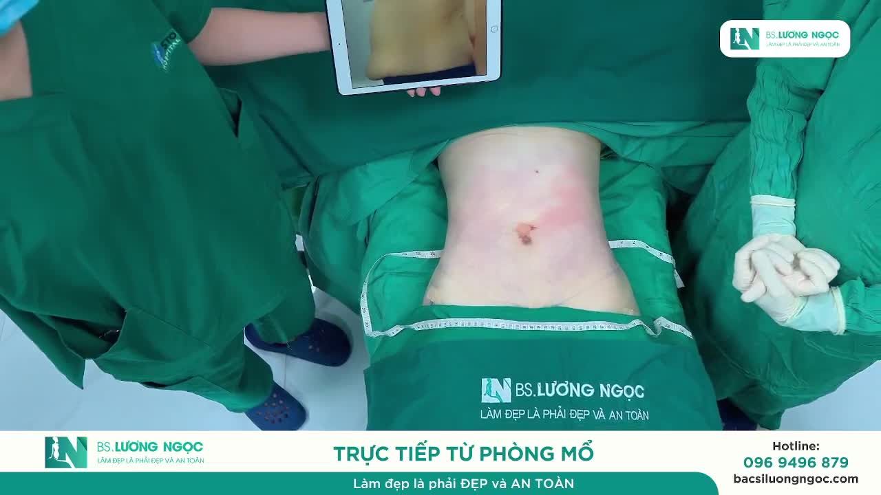 HÚT MỠ BỤNG – TẠO DÁNG – SIẾT EO - CO HỒI DA