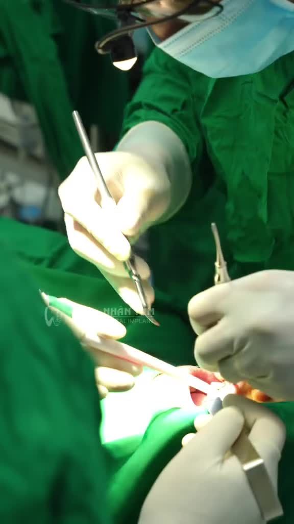 TIÊU XƯƠNG LÂU NĂM – VẪN HOÀN TOÀN CÓ THỂ CẤY GHÉP IMPLANT TOÀN HÀM