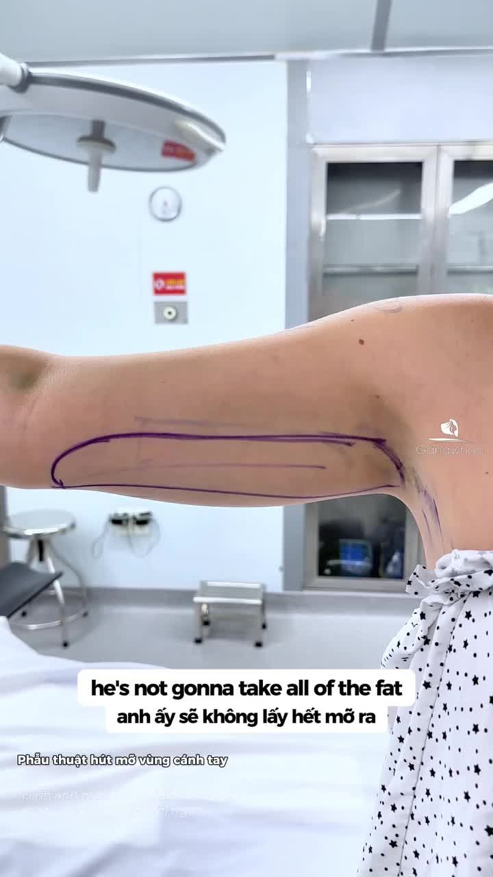 Kết quả sau 30 phút giảm mỡ bắp tay trên cho khách hàng quốc tế đến từ New Zealand